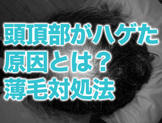 頭頂部がハゲてきた原因とは？薄毛対処法（予防と対策）